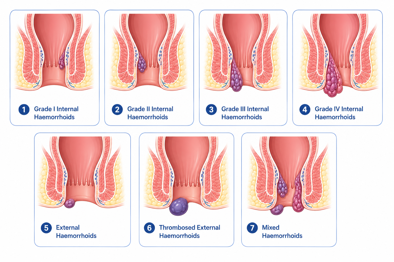 Haemorrhoidectomy