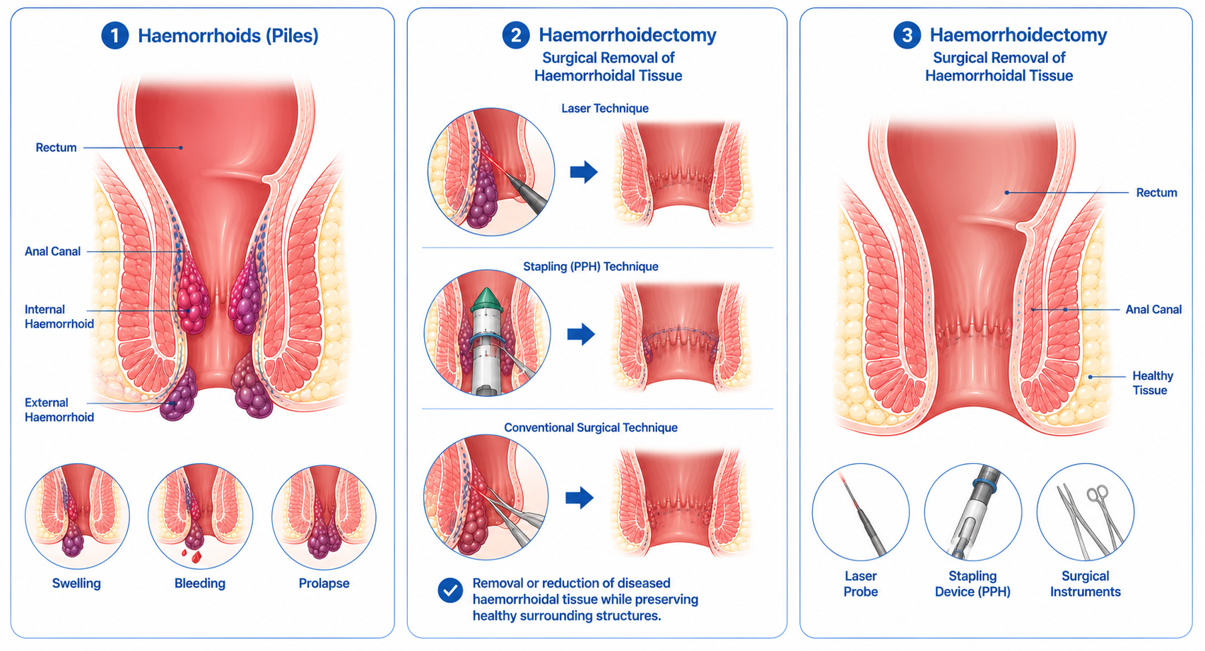 Haemorrhoidectomy