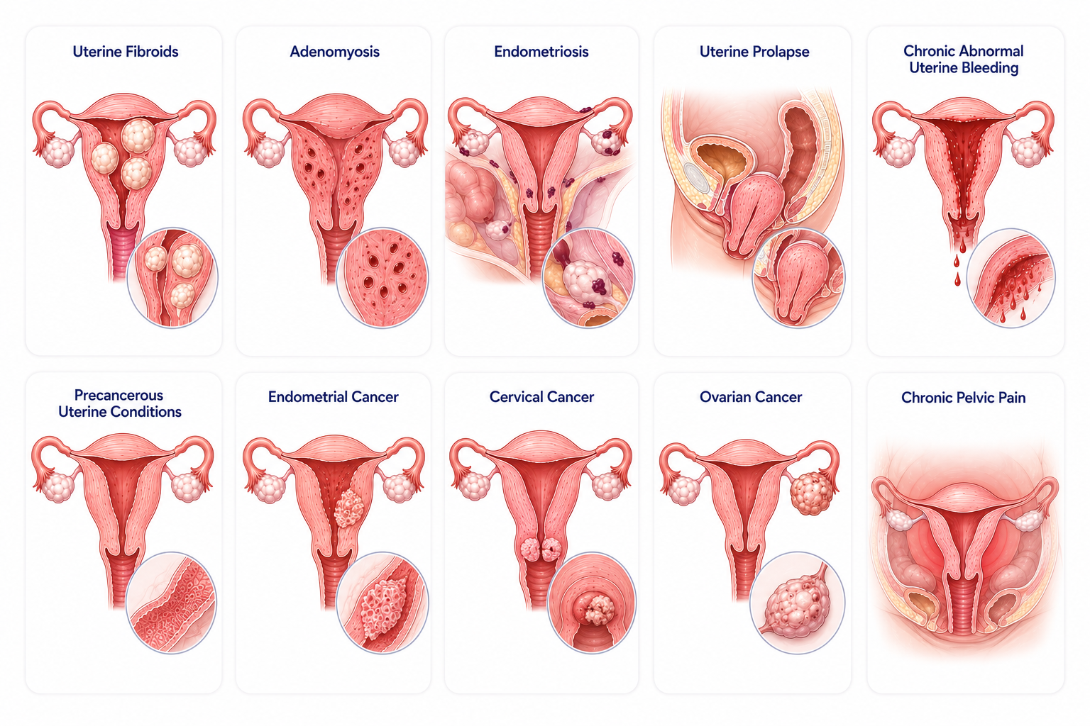 Hysterectomy