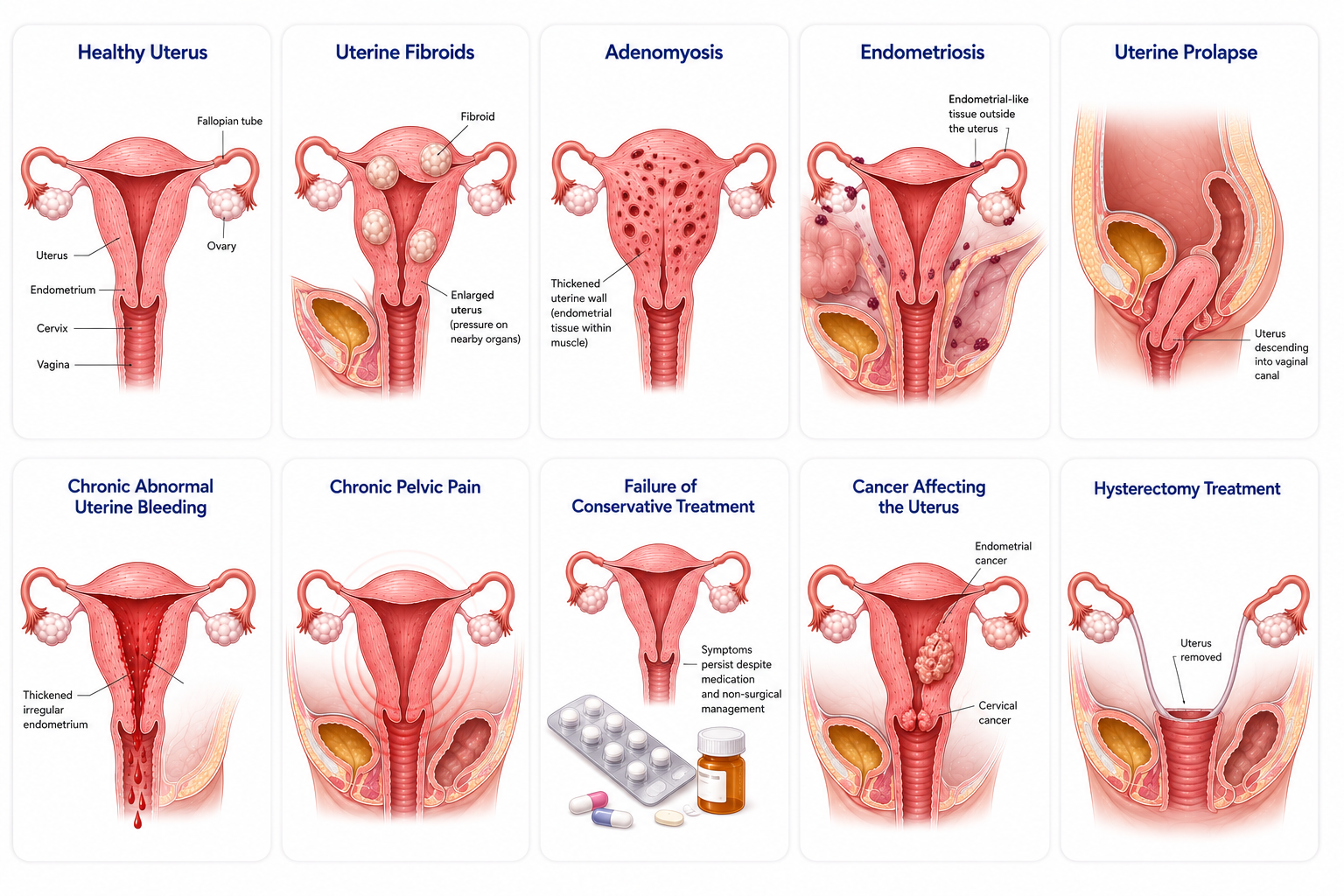 Hysterectomy