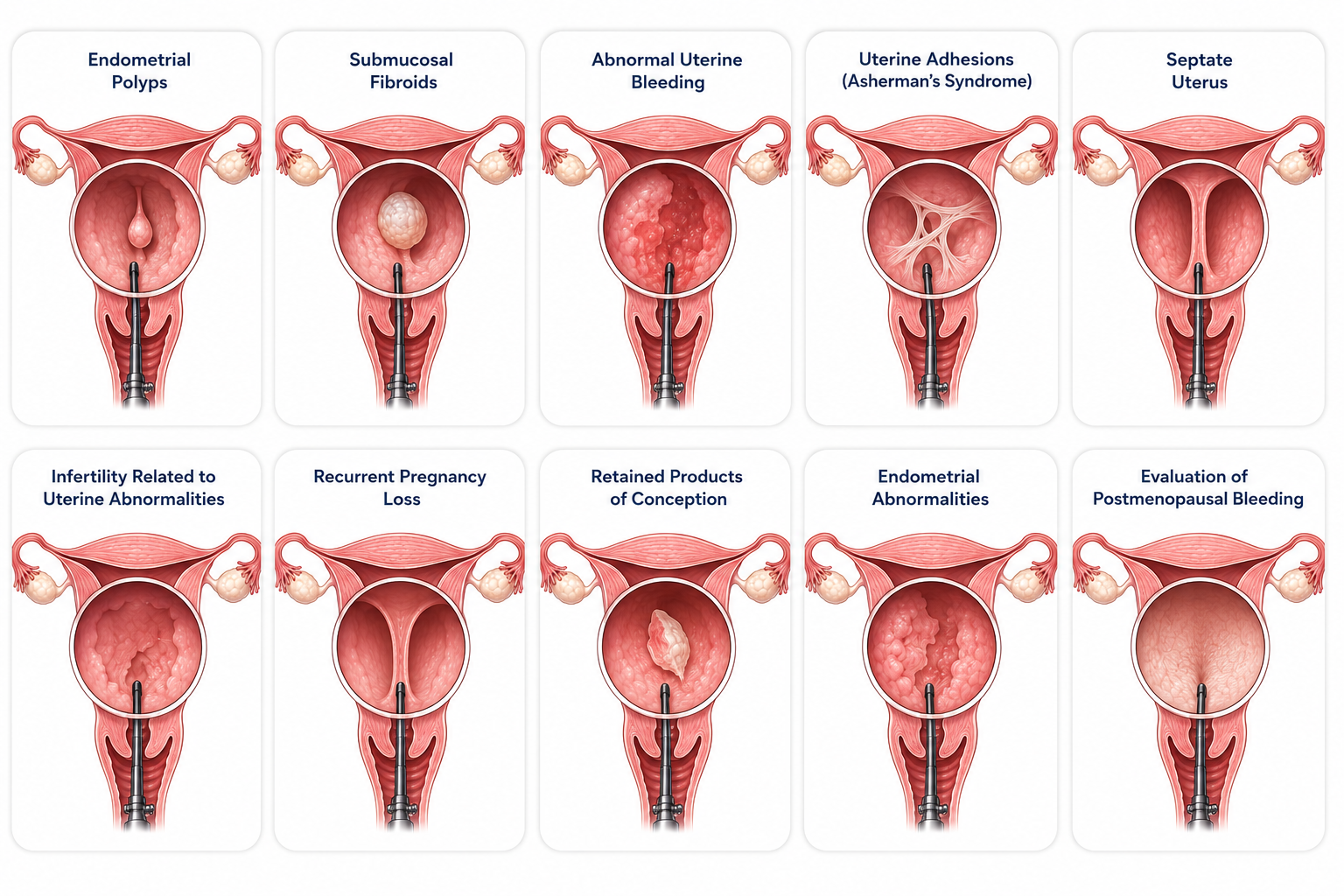 Hysteroscopy