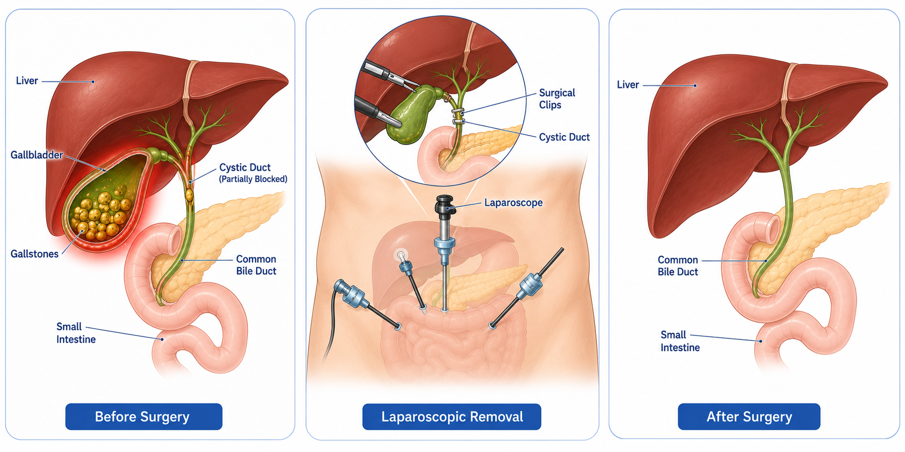 Gall bladder Removal