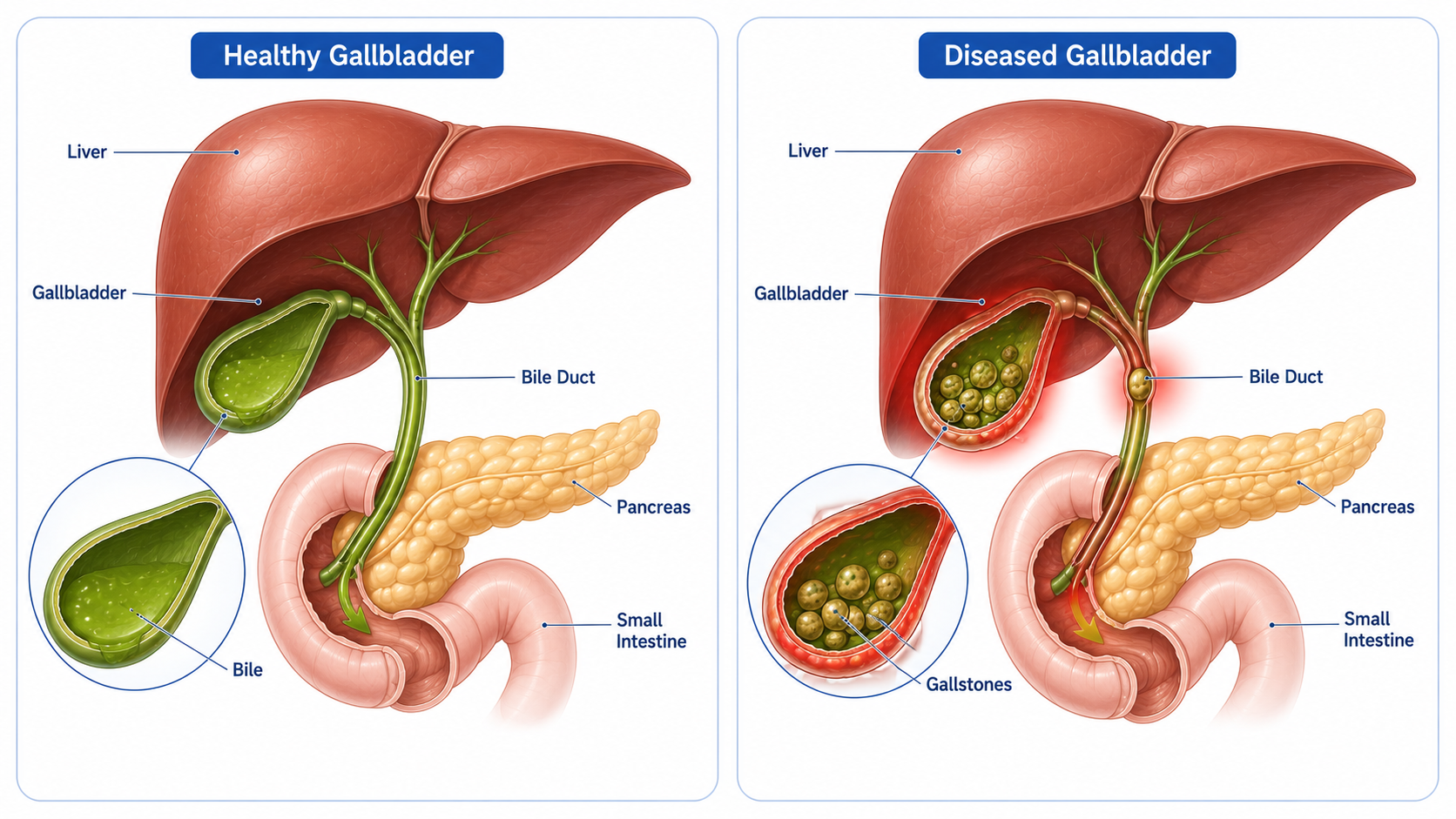 Gall bladder Removal