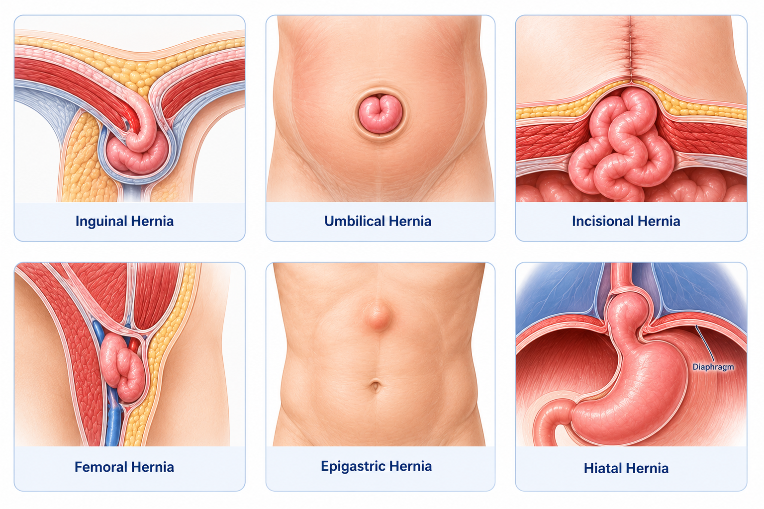 Hernia Surgery